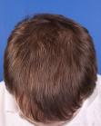 After Hair Transplant&nbsp;Front